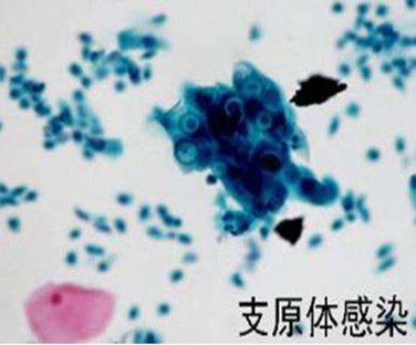 什么是衣原体，对试管婴儿有什么影响？