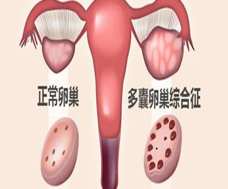 多囊性卵巢可以喝饮料吗?